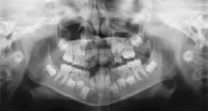 A black and white photo of teeth in the x-ray.