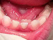A close up of the teeth and gums of a child