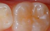 A close up of the teeth with white fillings