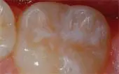 A close up of the teeth with white fillings